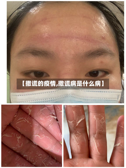 【撒谎的疫情,撒谎病是什么病】