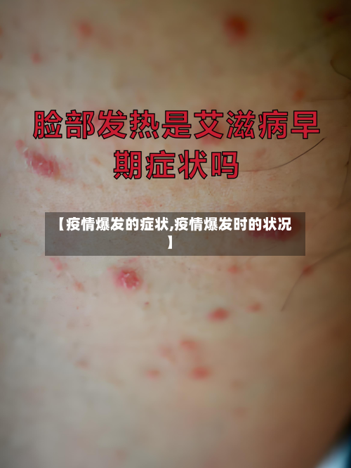 【疫情爆发的症状,疫情爆发时的状况】-第2张图片