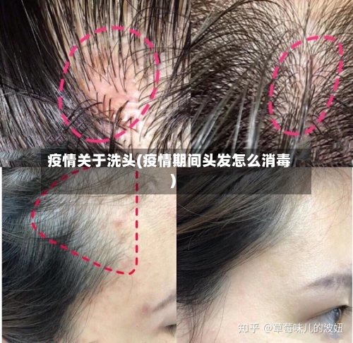 疫情关于洗头(疫情期间头发怎么消毒)-第3张图片